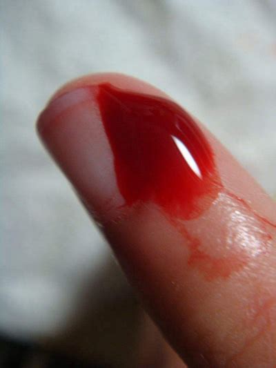 手指流血